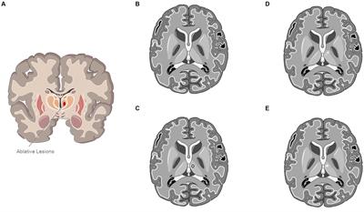 Cognitive safety of focused ultrasound thalamotomy for tremor: 1-year follow-up results of the COGNIFUS part 2 study